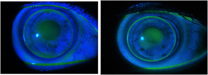 Figure 4. Custom GP fitting with no apical touch and with good lacrimal exchange and centration.