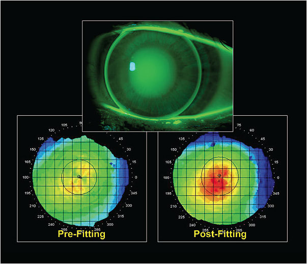 Figure 2. Corneal steepening with a back-aspheric GP multifocal lens.