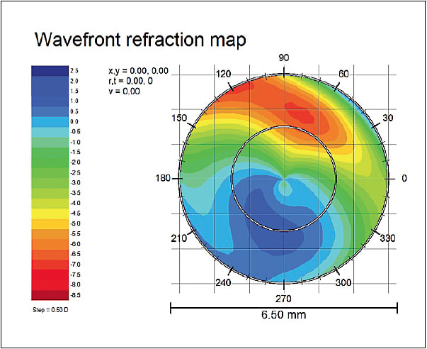 Figure 2. Wavefront map OD with a best-corrected scleral lens of the patient in Figure 1.