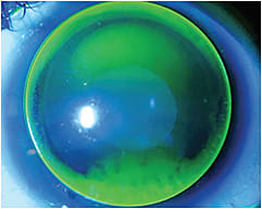 Figure 10. A toric corneal GP contact lens with insufficient back-surface toricity on a toric cornea.
