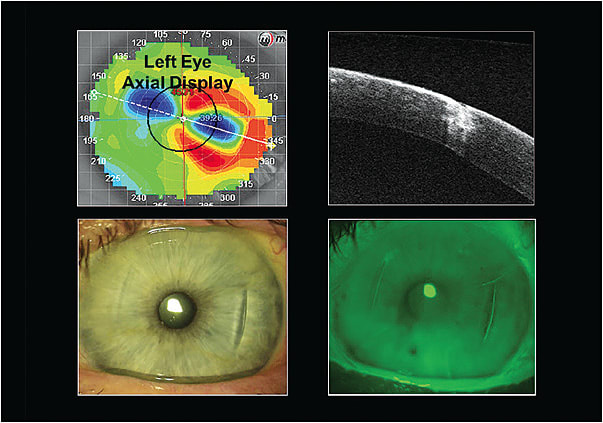 Figure 1. Patient&#x2019;s left eye topographically and with OCT following RK and AK.