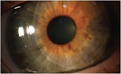 Figure 2. A taut lower lid pushes this hybrid lens superior-temporally. This patient complained of discomfort with hybrid lens wear, warranting a fit modification (video available online).