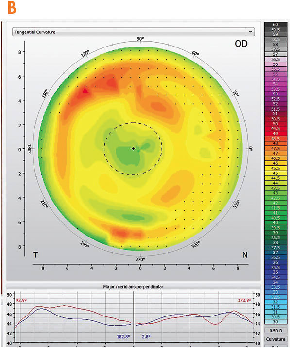 Figure 2. (B) A tangential map enhances the detail of the peripheral cornea after about two weeks of lens wear.