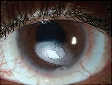 FIGURE 8. Front-surface film and plaque development on a scleral lens with a keratoconus patient having severe ocular allergies.Photo courtesy of Gloria Chiu, OD.