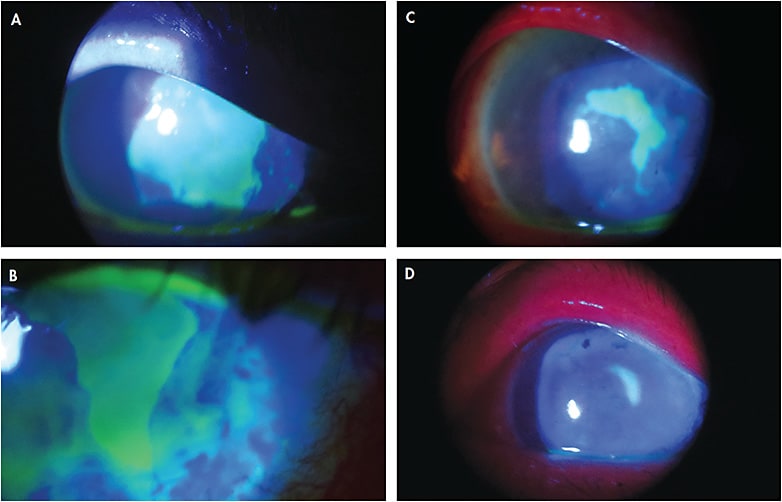 Figure 2. (A) Patient from Case #2 at initial visit; (B) after three days of amniotic membrane use; (C) two weeks post-amniotic membrane application; (D) one month post-amniotic membrane application.