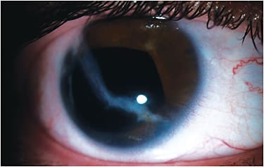 Figure 2. A clinical application in which a custom soft, large-diameter, hand-painted lens design would be useful to mask the exodeviation, corneal scar, and iris injury seen here.