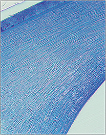 Figure 4. Lamellar splitting is theorized to cause the biomechanical weakness that results in corneal ectasia. Republished with permission from JPG Bergmanson, Clinical Ocular Anatomy and Physiology, Edition 25, 2018.