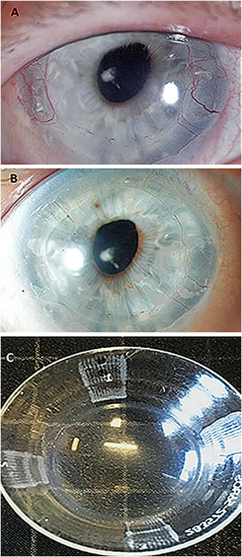 Figure 5. Increased neovascularization and edema along the graft-host junction in a post-PK cornea secondary to Fuchs&#x2019; dystrophy (A). The material was Boston XO2 (Dk 141) (Bausch &#x2B; Lomb) with CT of 250&#x3BC;m at the time. Edema and neovascularization resolved after adding channels under the haptic surface at 3 o&#x2019;clock and 9 o&#x2019;clock to prevent/minimize suction (B). An example of channels added in four meridians&#x2014;such as the ones added in the case above and in similar cases to promote tear exchange and minimize/prevent suction (C).&#xD;&#xA;Image courtesy of Karen G. Carrasquillo, OD, PhD