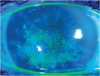 Figure 1. This patient developed a patchy keratopathy, later diagnosed as early Acanthamoeba keratitis, after wearing soft contact lenses while using a hot tub.Photo courtesy of the Francis I. Proctor Foundation/UCSF.