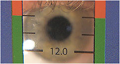 Figure 2. Close up of HVID ruler held against a patient’s ocular bones.