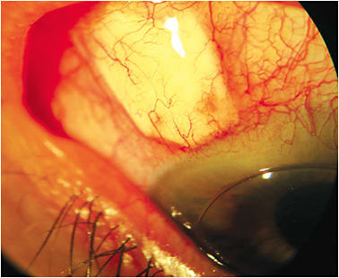 Figure 3. A glaucoma drainage device with an over-lying scleral patch may be a challenge when fitting a scleral lens. This eye is fitted with a corneal lens. Image courtesy of Karen Lee.