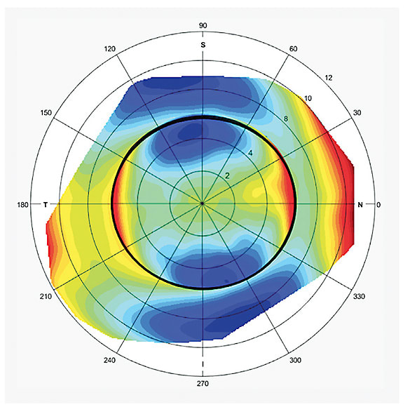 FIGURE 3. The with-the-rule corneal astigmatism extends beyond the limbus (demarcated by the black circle) onto the sclera. Figure courtesy of Greg DeNaeyer, OD