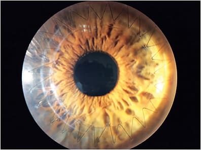 Figure 1. One-month post-op femtosecond laser-assisted penetrating keratoplasty (PK) utilizing a mushroom incision with a 9.0mm anterior diameter and 7.5mm posterior diameter. Note overlap of tissue at the graft-host junction.