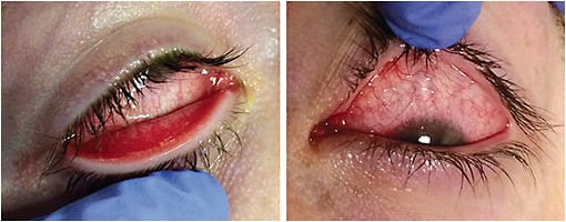 Figure 1. Acute EKC with significant bilateral injection and follicular reaction.