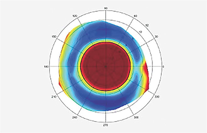 Figure 5. Pingecula on the nasal aspect of the sclera.