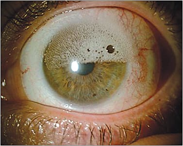 Figure 1. An example of “frothing” caused by air bubbles trapped beneath a large-diameter scleral lens.