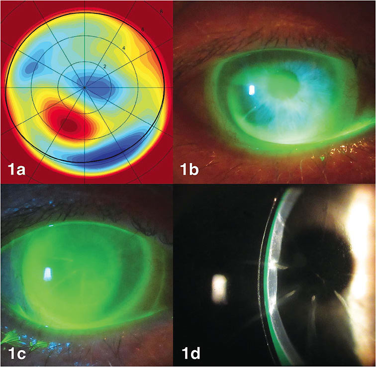 Figure 1. (a) Corneal elevation map OD. (b) Best-fit diagnostic lens showed bearing at area of ectasia. (c) Fluorescein pattern of a custom scleral lens showing even vaulting over a flattened central cornea. (d) The lens also vaulted the area of ectasia.