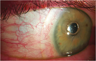 Figure 2. Sectorial blanching from the SL restricting conjunctival blood vessels.