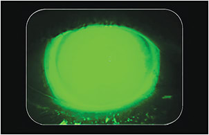 Figure 4. Fluorescein pattern of the 14.8mm scleral lens design on the patient&#x2019;s right eye.