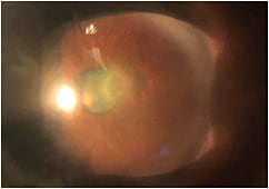 Figure 1. Baseline central corneal defect in the right eye.