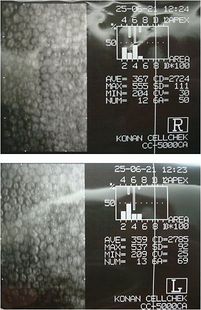 Figure 3. Specular microscopy OD and OS.