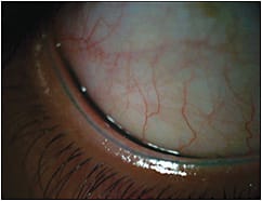 Figure 2. The position of the line of Marx was different for contact lens wearers.