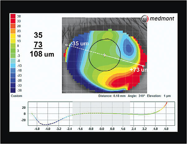 Figure 3. Elevation display map of the patient’s left eye.