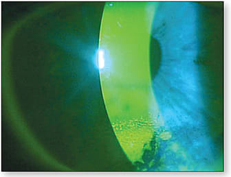 Figure 2. Evident corneal staining.