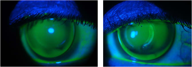 Figure 2. The aspheric GP final fitting fluorescein patterns OD and OS.