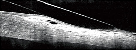 Figure 4. OCT image of a region of conjunctival prolapse adjacent to the limbus during non-fenestrated scleral lens wear.Image courtesy of Damien Fisher.