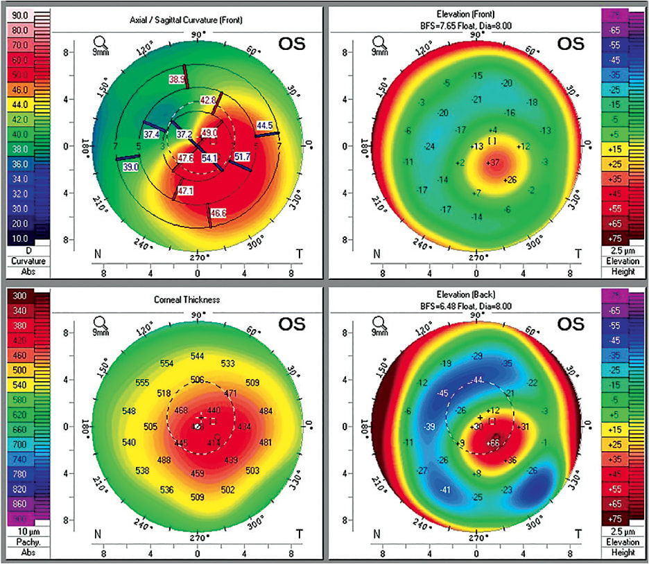 Figure 6. Tomographic elevation maps of keratoconus (upper and lower right). Posterior elevation maps are helpful in providing information about potential visual acuity that can be expected with contact lenses. An increase in elevation is associated with degradation in visual acuity.