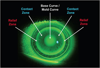 Figure 2. With a hyperopic ortho-k lens, there is a relief zone in the midperiphery.