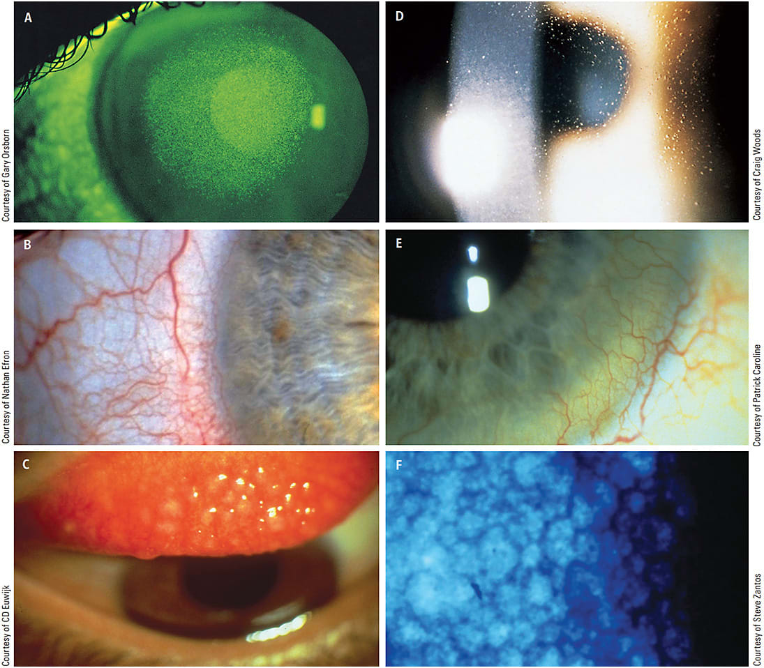 FIGURE 1. Complications encountered with early-generation hydrogel lenses. (A) corneal staining; (B) conjunctival redness; (C) papillary conjunctivitis; (D) epithelial microcysts; (E) stromal neovascularization; and (F) endothelial polymegethism.