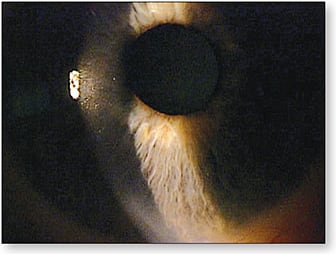 Figure 3. Corneal staining not visible with standard slit lamp evaluation.