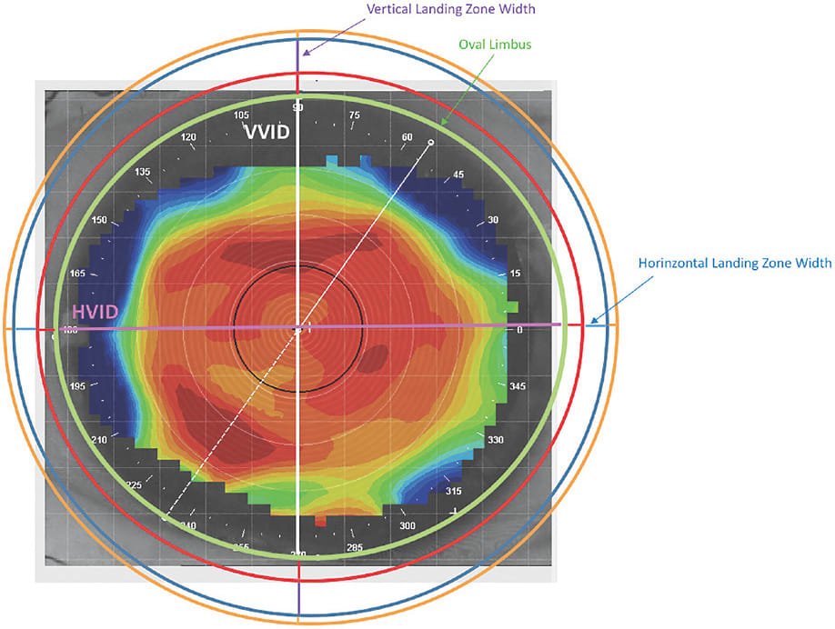 Figure 5. Illustration showing the limbal zone on an eye with an oval-shaped limbus. The landing zone has a different width in the two meridians that compensate for the oval shape and make the lens round. In this design, VID and landing zone values are different in the two axes, while limbal zone and last peripheral zone width have the same value in the two axes.