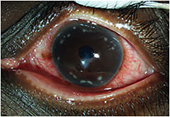 Figure 1. Multiple peripheral sterile infiltrates seen in a keratoconus patient who slept in contact lenses.Photo courtesy of Gloria Chiu, OD.