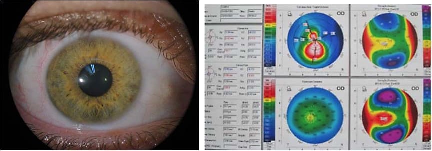 Figures 2 and 3. Anterior eye examination and anterior segment tomography map.