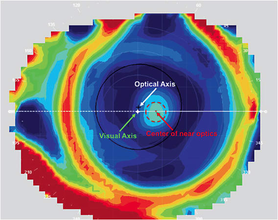 Figure 1. Topography over the lenses was used to evaluate the mismatch between the lens near optics and patients&#x2019; visual axis.&#xD;&#xA;Courtesy of Stephanie Ramdass, OD, MS