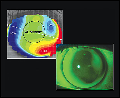 Figure 4. The fluorescein pattern of the left eye matches the elevation map.