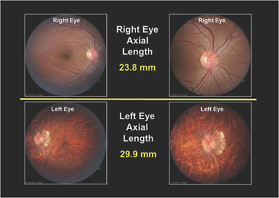 Figure 2. The retinal imaging and axial length measurements of the patient&#x2019;s right and left eyes.