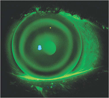 Figure 4. A typical hyperopia ortho-k treatment showing central steepening on the fluorescein pattern.