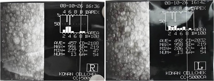 Figure 6. The specular microscopy (left) OD and (right) OS.