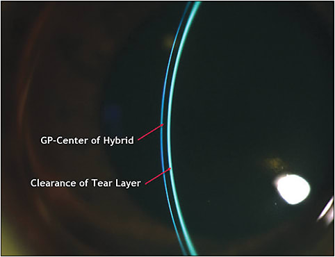 Figure 2. Optic section with fluorescein instilled over the lens to highlight the front surface of the GP center. The thickness of the tear layer is approximately half the thickness of the GP portion of the hybrid lens.