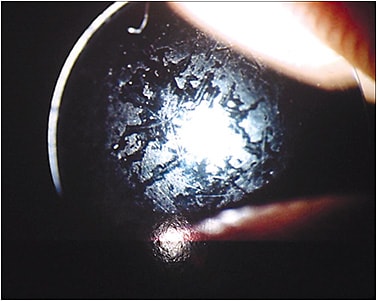 Figure 1. GP corneal lens with heavy protein coating.