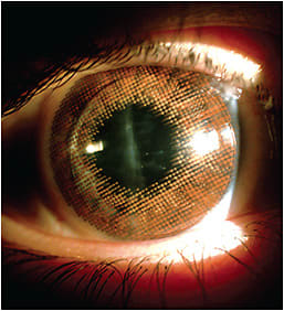 Figure 2. A soft colored lens piggybacked with a large-diameter corneal GP lens.