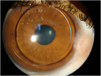 Figure 2. Pterygium entering into the peripheral cornea.