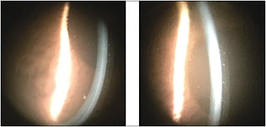 Figure 3. Debris in the reservoir. The images show a turbid liquid layer behind the lens and the presence of small white mucous debris.