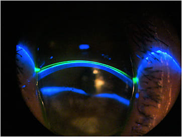 Figure 12. Slit lamp cross section view (OD).