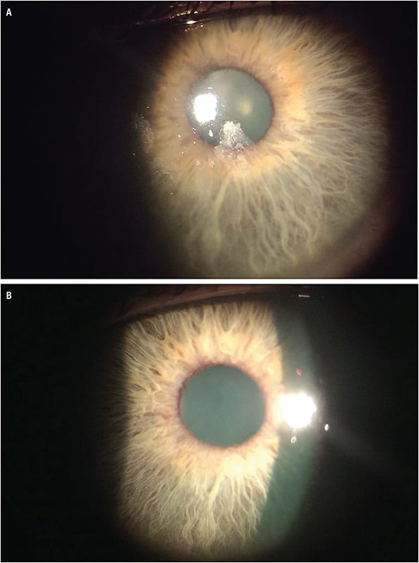 FIGURE 7. (A) Image of a diagnostic scleral lens showing poor wettability during slit lamp observation. (B) Image of the same eye after applying a daily soft contact lens on top of the scleral lens.Images courtesy of Anith Pillai, OD.