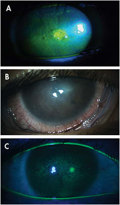 Figure 1. Anterior segment photography of stage 3 NK (A); amniotic membrane treatment (B); and three-day post-amniotic membrane therapy (C).